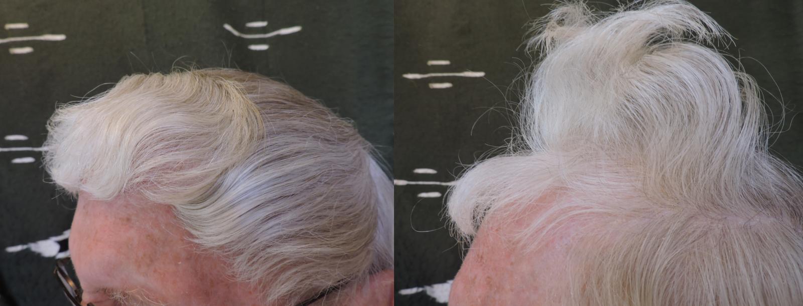Miracle ! Repousse des cheveux à 84 ans avec une alimentation instinctive